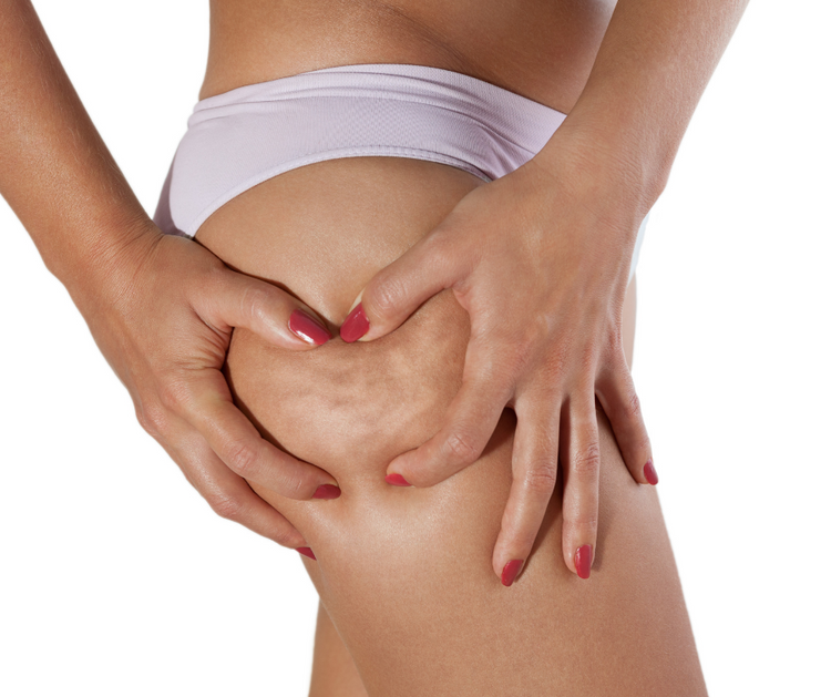 Cellulite